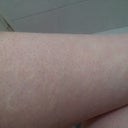 White Bumps After Laser Hair Removal Will It Get Better Photo