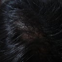 Hair Thinning Hair And Dandruff And Itchy Scalp Is There Any