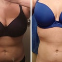 Size 30i to 30e. 824g removed. Canadian. - Review - RealSelf