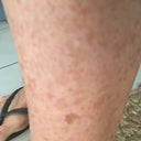 Removal Of Age Spots Sun Spots On Hands Arms And Legs Photo