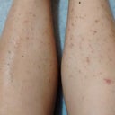 What Is The Cheapest And Most Effective Way To Remove Leg Scars