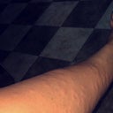 What Caused My Red Itchy Bumps Rash On My Legs After My Second