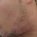 Minoxidil For Beard Growth How To Induce Terminalisation Of