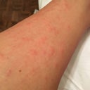 1 Day Post Laser Hair Removal And Experience Very Itchy Red Bumps