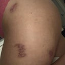 Can I Do A Bbl Round Two Even If Scars Isn T Healed Photos