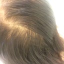 My Hair Is Thinning With Very Shiny Scalp And Vellus Hair All Over