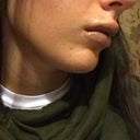 I Got 1 5ml Teosyal Kiss Injected Into My Lips 4 Days Ago And I Hate Them Is This Just Swelling And Will It Go Down Photos