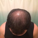 Hair Transplant For Diffuse Thinning On The Top Of My Scalp 27 28