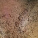 What Are These Red Bumps On My Scrotum Testicles Photos Doctor