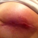 2 Holes On Incision 4 Months Post Op That Won T Heal Why Ps