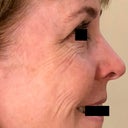 Smartxide Dot Laser Treatment Realself
