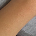 I Got Ingrown Hair After My First Laser Hair Removal Is It
