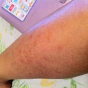 Raised Bumps Scarring From Plucking Out Ingrown Hair Photo