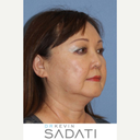 Have You Always Wanted a Chiseled Face? Learn About Buccal Fat Removal -  Ali Sajjadian, MD