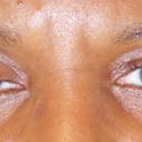 203 Eyelid Surgery Doctors In Fairfax Va Realself Blepharon, eyelid + plassein to form) is the plastic surgery operation for correcting defects, deformities, and disfigurations of the eyelids; realself