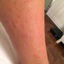 1 Day Post Laser Hair Removal And Experience Very Itchy Red Bumps