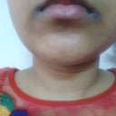 What Is The Best Way To Get Rid Of Angular Cheilitis Splits That Occur At The Corners Of Your Mouth Quora