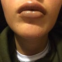 I Got 1 5ml Teosyal Kiss Injected Into My Lips 4 Days Ago And I Hate Them Is This Just Swelling And Will It Go Down Photos