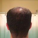 Hair Transplant For Diffuse Thinning On The Top Of My Scalp 27 28