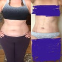 Airsculpt - 1 Week Post Op (Full Abdomen, Inner Thighs, Up-A-Cup)