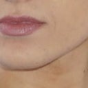 2 Line Filler – So Far Lost How to Tell If Your Nasolabial Fold Filler Has Flopped