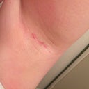 One Week Post Laser Hair Removal And Still Red And Itchy With