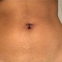 Belly Button Piercing Repair CLNQ Knutsford Cheshire