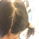 My Hair Is Thinning With Very Shiny Scalp And Vellus Hair All Over