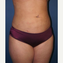 Liposuction - Greenville, SC