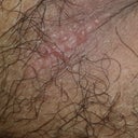 What Are These Red Bumps On My Scrotum Testicles Photos Doctor