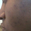 Is A B Liftx Peel Safe For Black African Skin