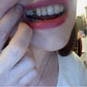 Are There Any Less Expensive Options To A Flip Tooth To Fill The Gap In My Mouth While I Wait To Get An Implant Photo