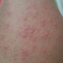 Why Do I Have White Itchy Bumps After My First Diode Laser Hair