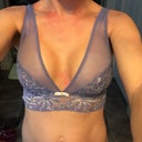 Silicone Breast Augmentation 32A to 32C - Conkright Aesthetics