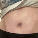 Tummy Tuck Before and After Photos Baltimore - Plastic Surgery Gallery  Columbia - Dr. Daniel Markmann