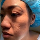 Mixto Laser Skin Resurfacing Realself