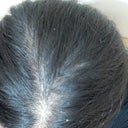 Hair Loss And Extreme Shedding All My Hair Have White Bulbs