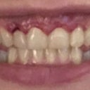 Gum Contouring In Singapore Perfect Ratio Of Gum To Teeth