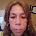 I M Not Sure If I Have Malar Bags Or Festoons I Have Swelling