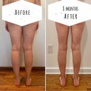 Amy's Dramatic Thigh Gap and Hourglass Shape With Leg AirSculpt
