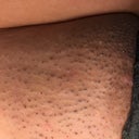 Am I Supposed To Get Ingrown Hair Coming Out Two Days After First