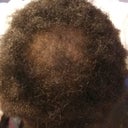 21 Year Old Black Male Hair Thinning In Front And Balding At