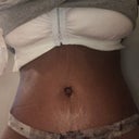 tummytuck84