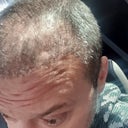 After 6 months of hair transplantation: I'm not happy with
