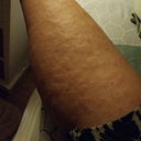 Red Itchy Bumps On My Lower Legs After Hair Removal Will It Go