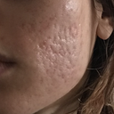 My CO2 Laser + Filler + Microneedling Update & Thoughts… : r/AcneScars