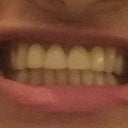 Permanent Dental Bridge Feels Loose What Could This Be Photos