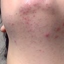 Prolonged Redness And Bumps 5 Days After Laser Hair Removal