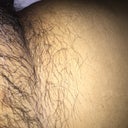 I Have Extreme Ingrown Hairs On My Pubic Area Would Laser