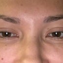 Will fat grafting help my tear troughs? (photos) Doctor Answers, Tips